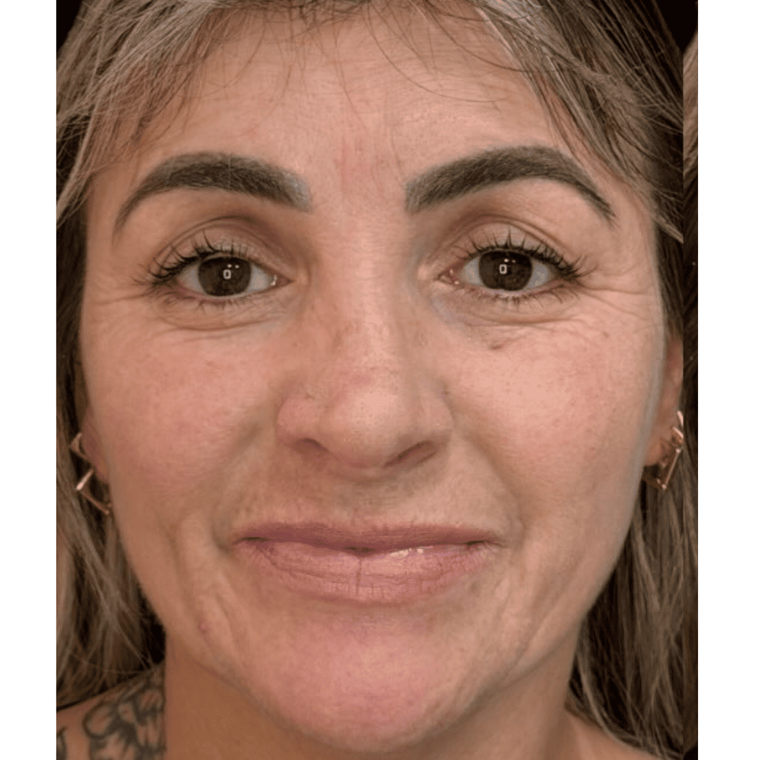 Resultado 02 — antes