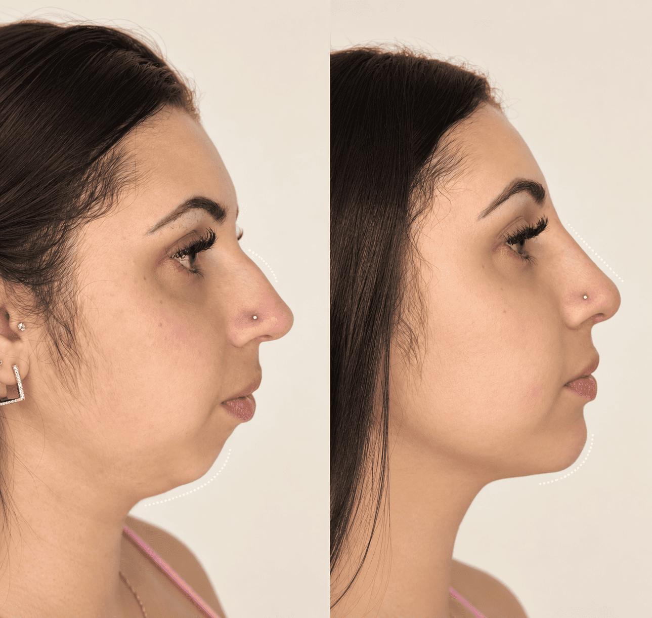 Antes e Depois do Perfil Facial Sculptado