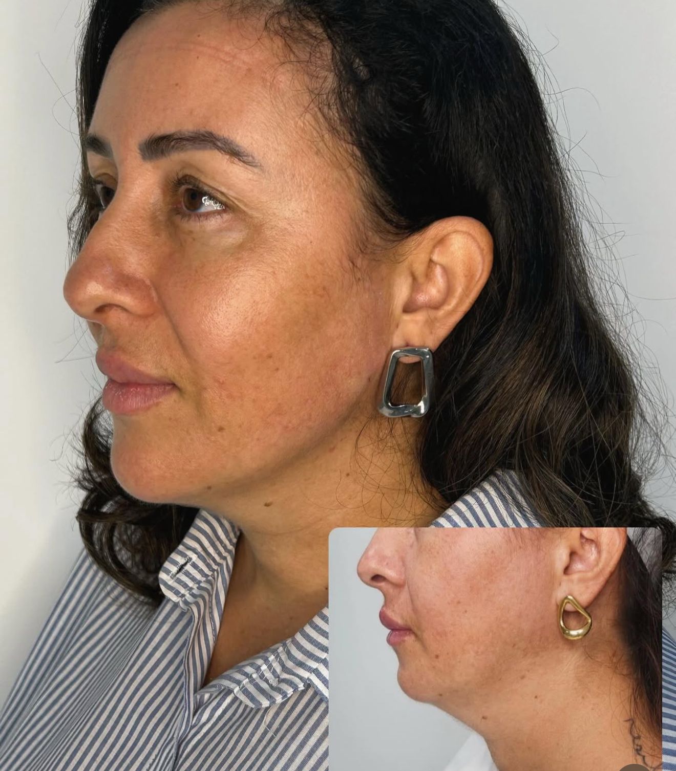 Antes e depois de preenchimento de mento
