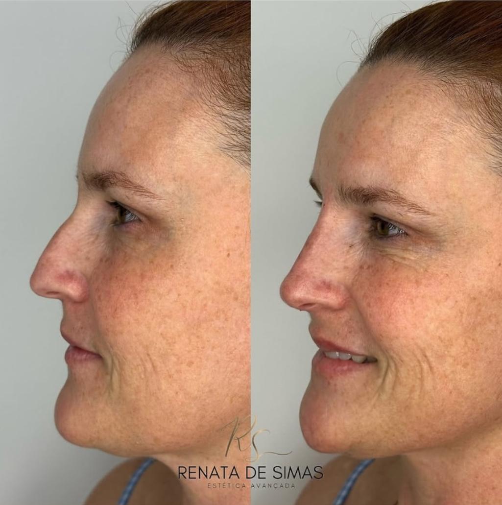 Antes e depois de rinomodelação em vista de perfil