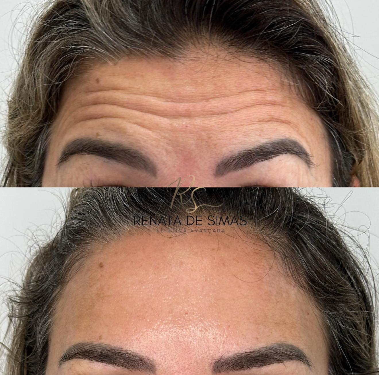 Antes e depois de toxina botulínica na testa